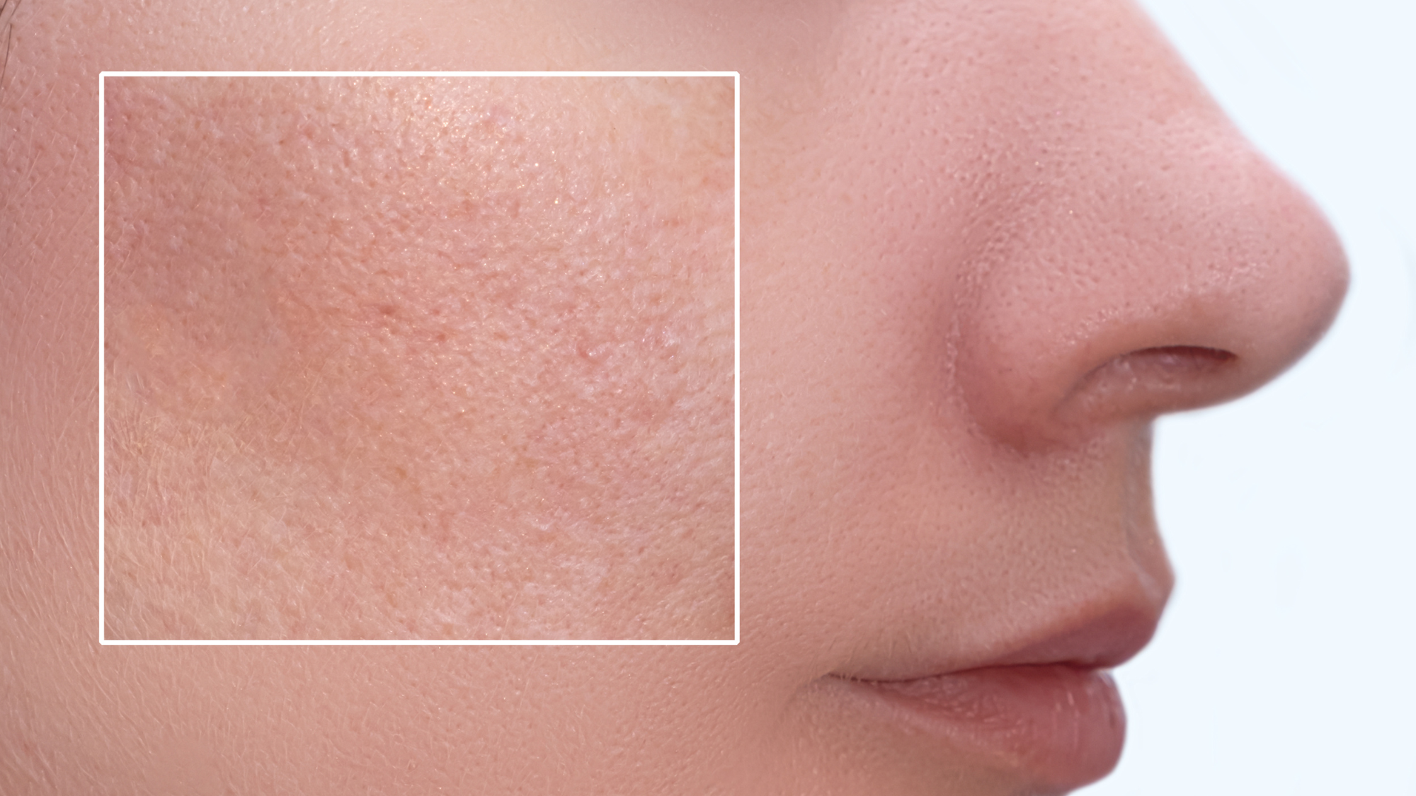 How Does Rejuran PN Address Enlarged Pores and Restore Skin Health?